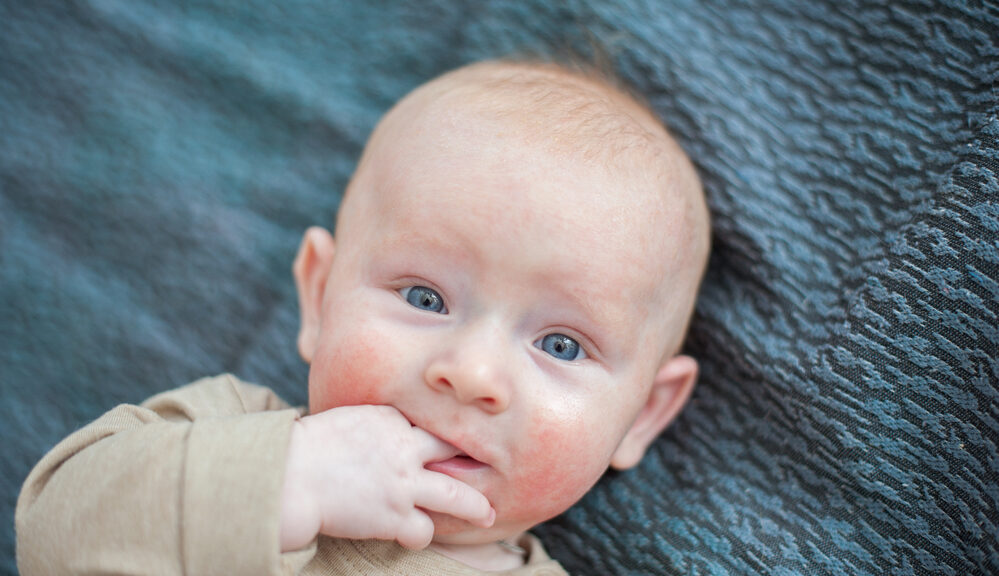 Dermatite atopica nel neonato: manifestazioni e cura